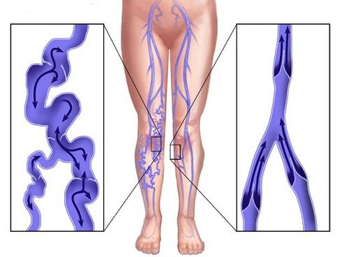 Comparación de venas afectadas por varicosa y venas después de usar el valor ZXCVBNMQ