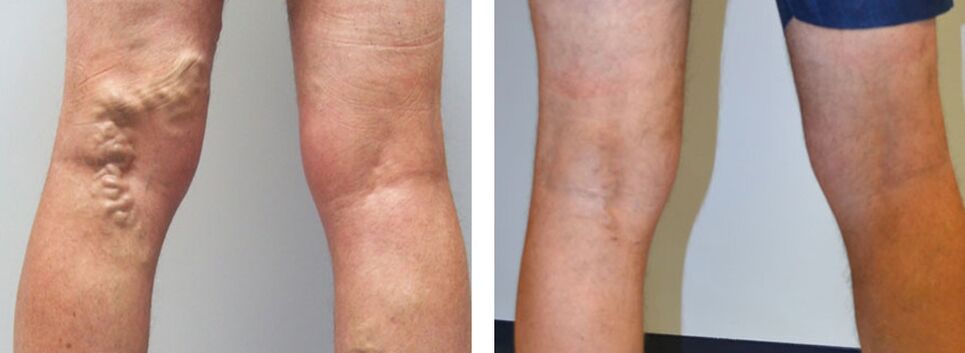 Foto antes y después de usar Veniselle, experiencia en el uso de crema