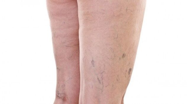 Síntomas de los vasos sanguíneos