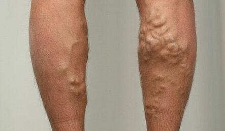 Síntomas de las venas varicosas