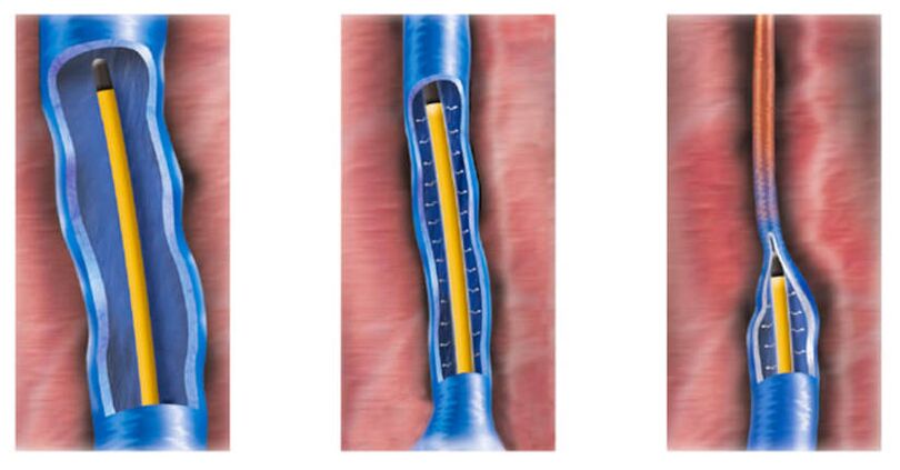 La ablación por radiofrecuencia como método para el tratamiento de las varices.