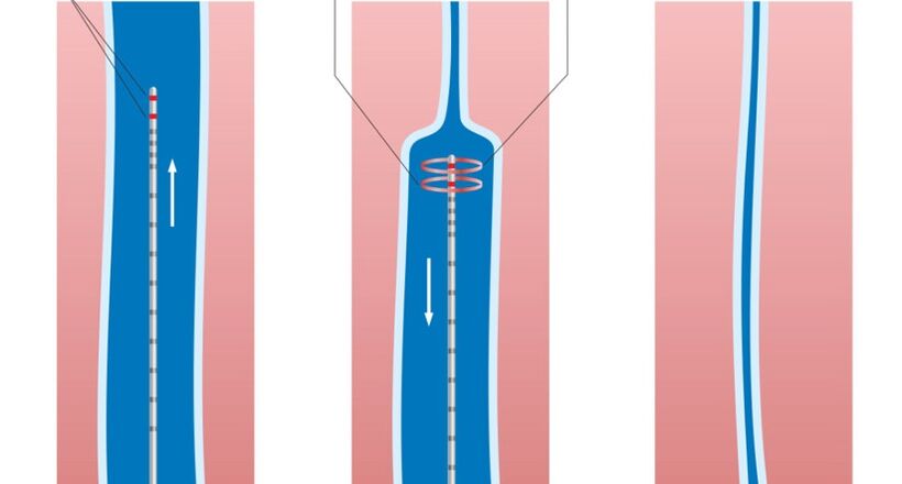 Tratamiento con láser de varices en las piernas.