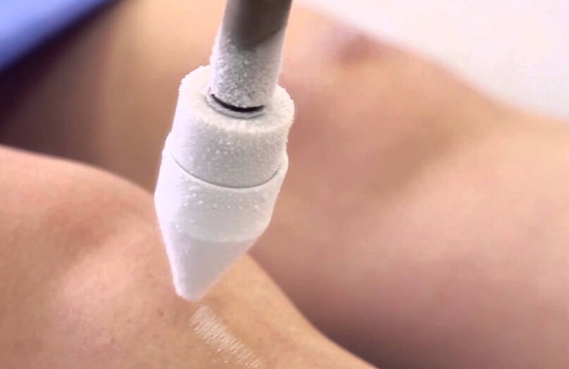 Tratamiento de las varices de las piernas con crioterapia.